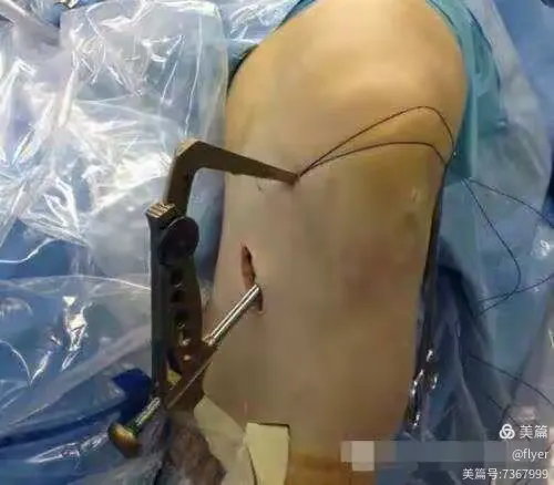我院成功开展第一例关节镜手术。